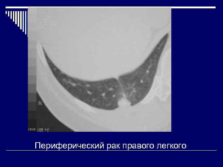 Периферический рак правого легкого 