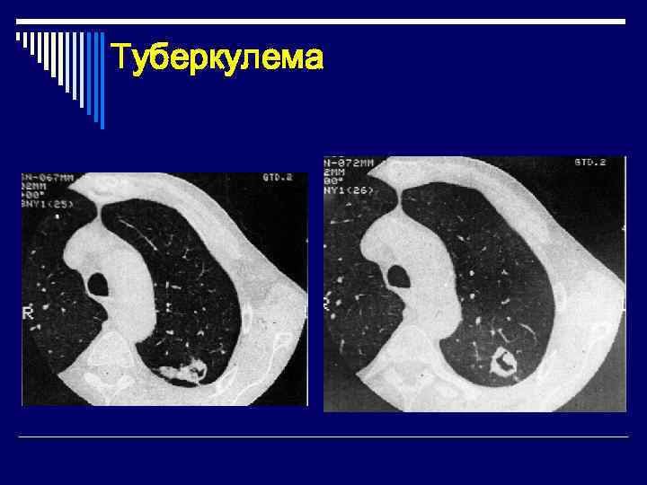 Туберкулема 