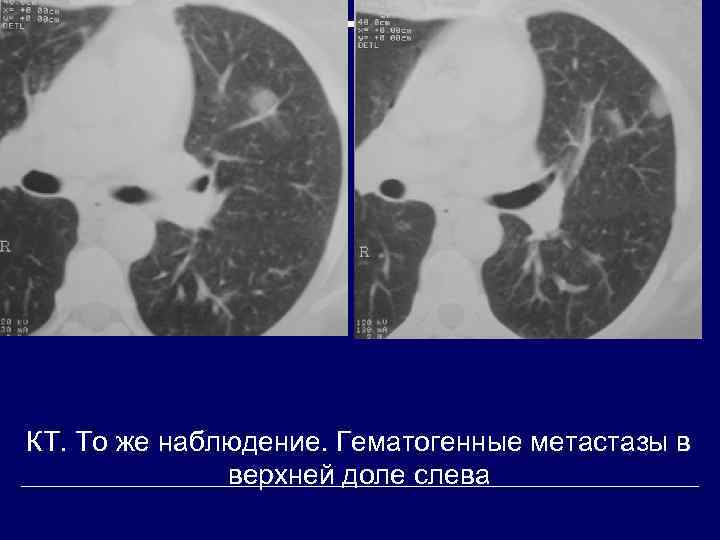 Мягкотканное образование в легком на кт. Гематогенные метастазы легкого на кт. Гематогенные метастазы в легких на кт. Шаровидные метастазы в легких. Гематогенное метастазирование в легкие.