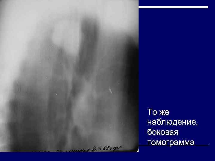 То же наблюдение,  боковая томограмма 