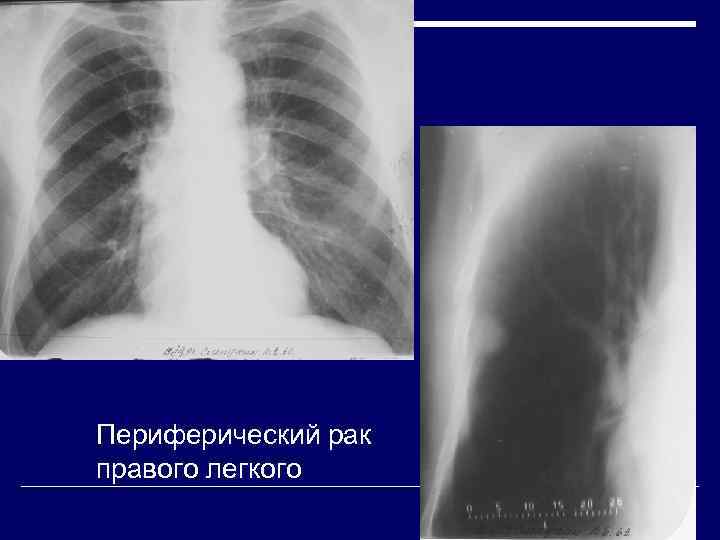 Периферический рак правого легкого 
