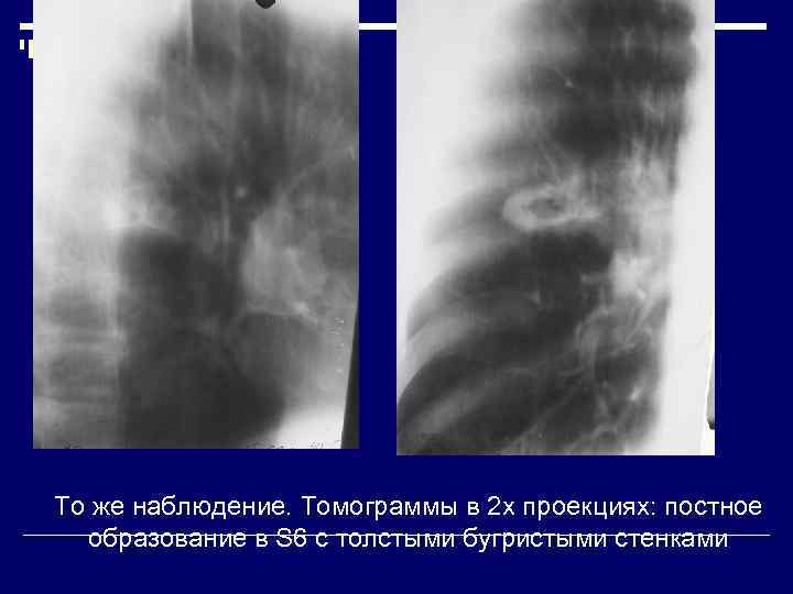 Бугристые контуры легких ,что это такое. Бугристое образование в легком. Периферическая опухоль легкого. Образование в легком с лучистыми контурами. Новообразование в легком.