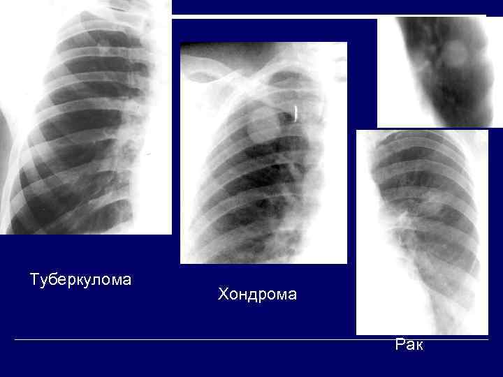 Туберкулома    Хондрома      Рак 