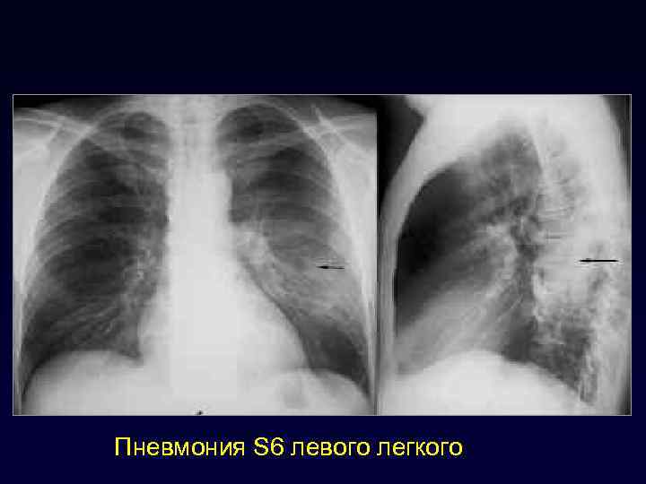 Пневмония S 6 левого легкого 