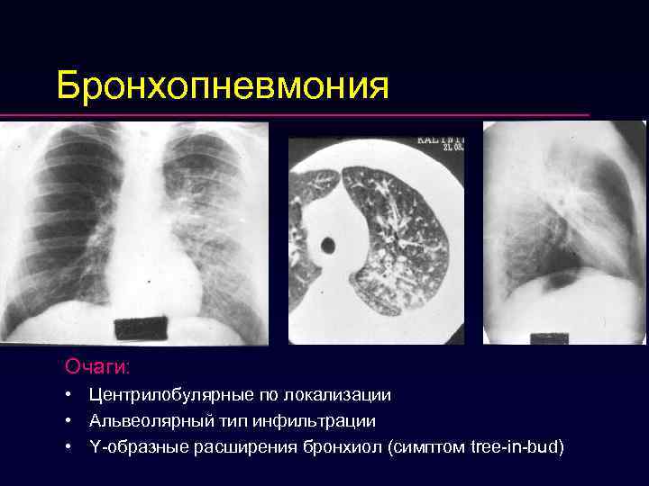 Бронхопневмония Очаги:  • Центрилобулярные по локализации • Альвеолярный тип инфильтрации • Y-образные расширения