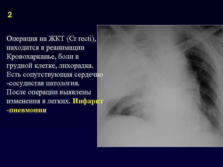 2  Операция на ЖКТ (Cr recti), находится в реанимации Кровохарканье, боли в грудной