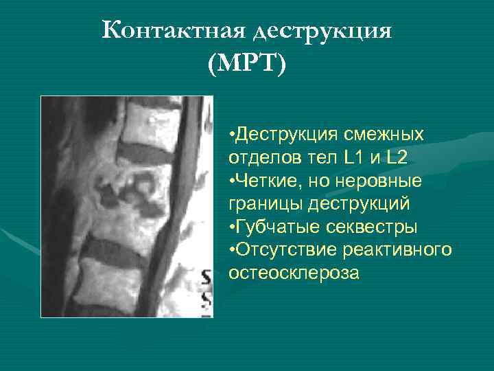 Контактная деструкция  (МРТ)  • Деструкция смежных   отделов тел L 1