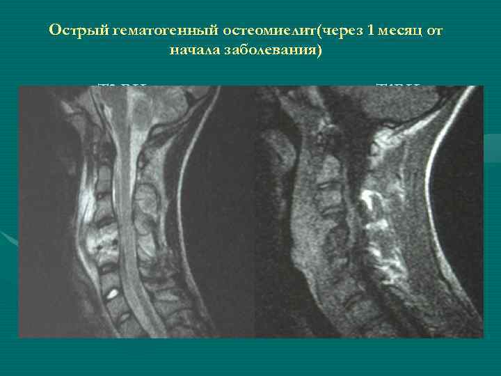 Острый гематогенный остеомиелит(через 1 месяц от    начала заболевания)  Т 2