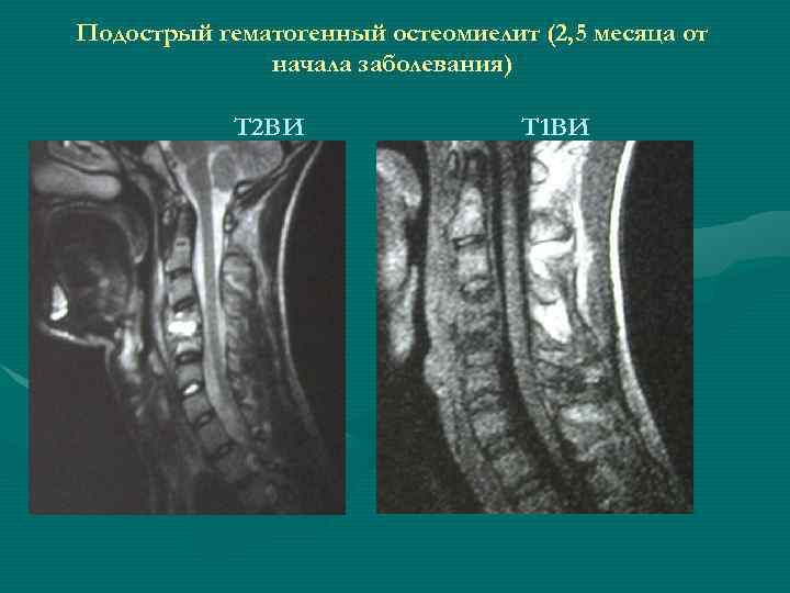 Подострый гематогенный остеомиелит (2, 5 месяца от    начала заболевания)  