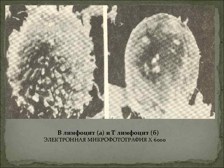 В лимфоцит (а) и Т лимфоцит (б) ЭЛЕКТРОННАЯ МИКРОФОТОГРАФИЯ X 6000 В лимфоцит (а) и Т лимфоцит (б) ЭЛЕКТРОННАЯ МИКРОФОТОГРАФИЯ X 6000