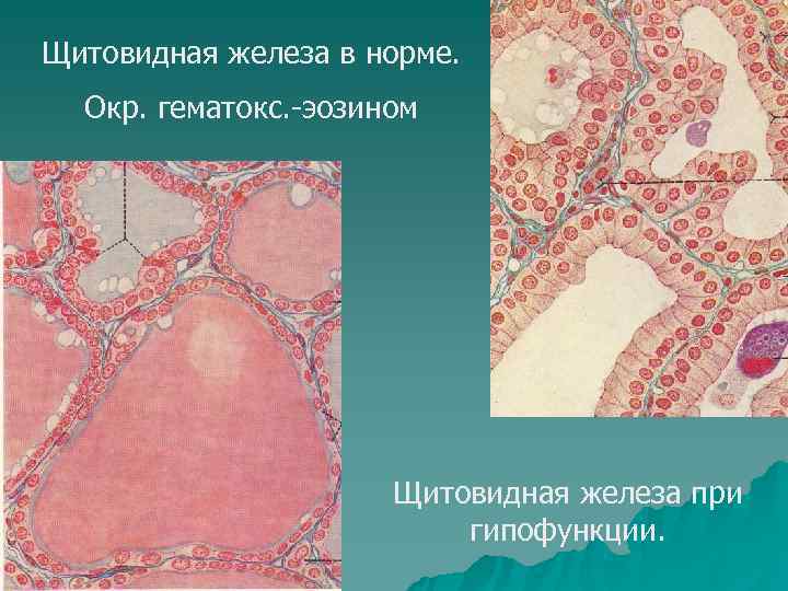 Щитовидная железа в норме.  Окр. гематокс. -эозином      Щитовидная
