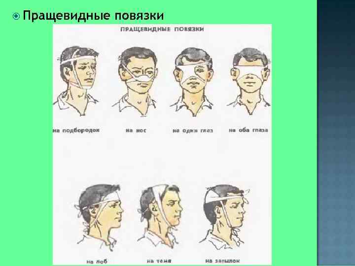  Пращевидные  повязки 