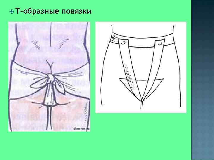  Т-образные  повязки 