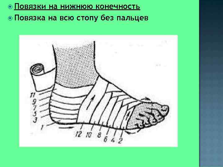  Повязки на нижнюю конечность  Повязка на всю стопу без пальцев 