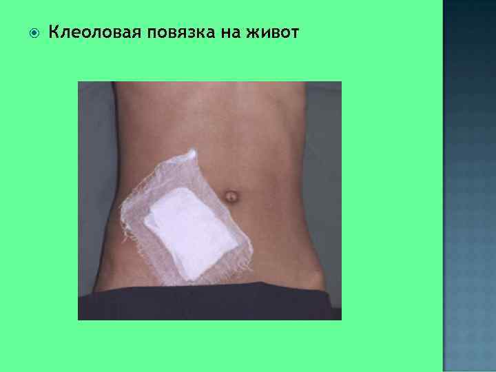   Клеоловая повязка на живот 