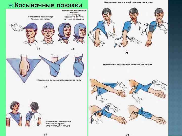 Перевязка косынка. Косыночные повязки. Наложение косыночной повязки на руку.