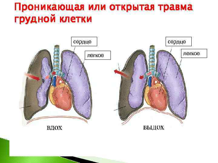 Проникающая или открытая травма грудной клетки  сердце    легкое 