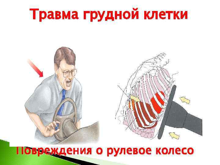 Травма грудной клетки Повреждения о рулевое колесо 