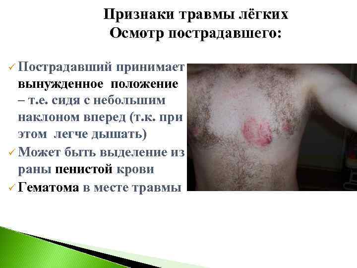    Признаки травмы лёгких    Осмотр пострадавшего:  ü Пострадавший