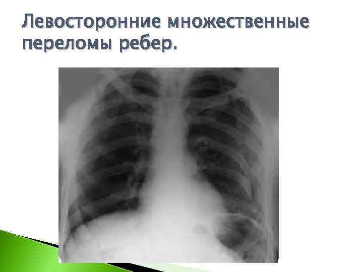 Левосторонние множественные переломы ребер. 