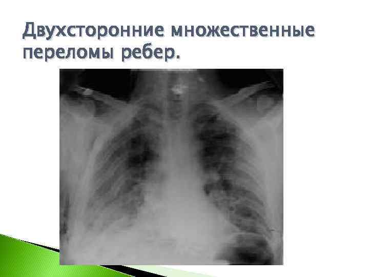 Двухсторонние множественные переломы ребер. 