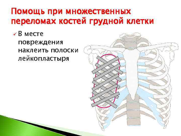 Множественные переломы ребер карта вызова