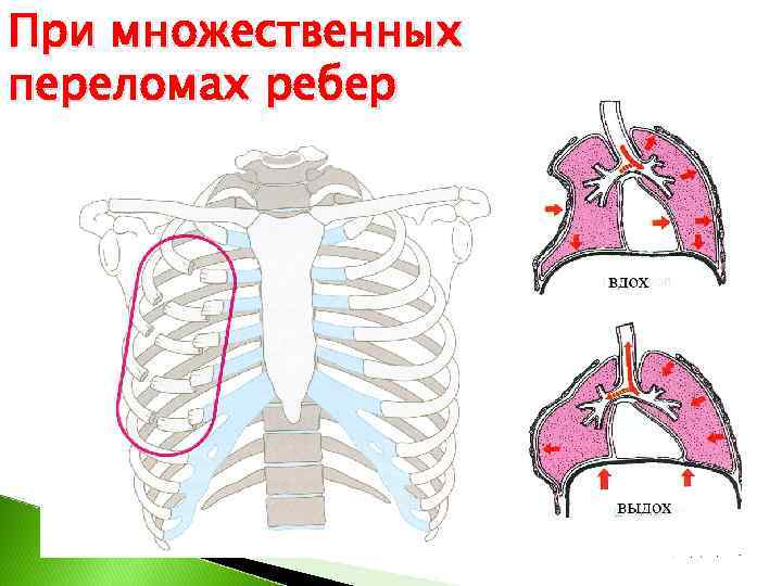 При множественных переломах ребер 