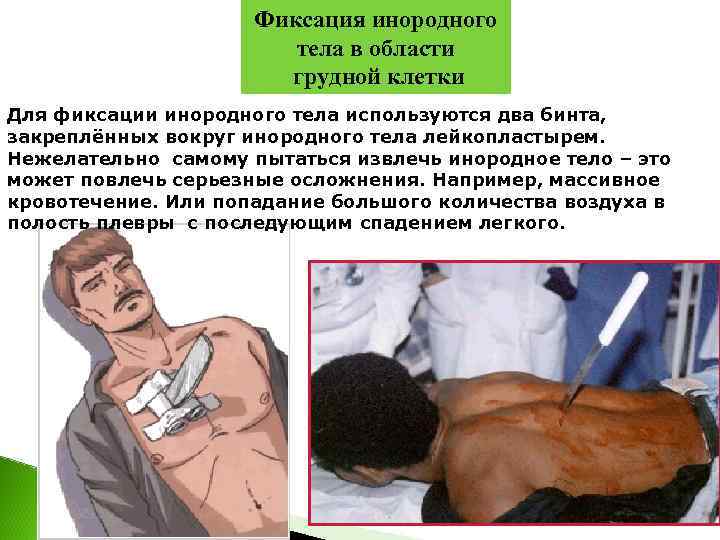      Фиксация инородного     тела в области