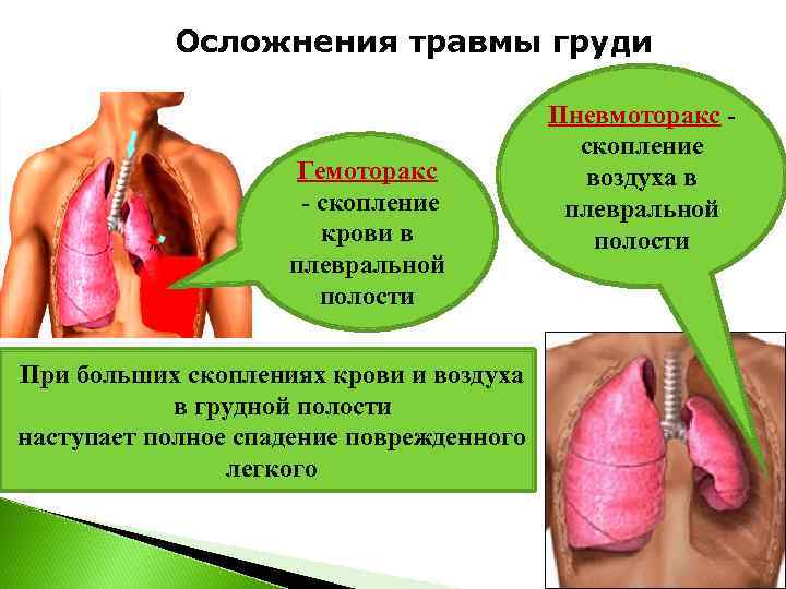   Осложнения травмы груди    Пневмоторакс -    