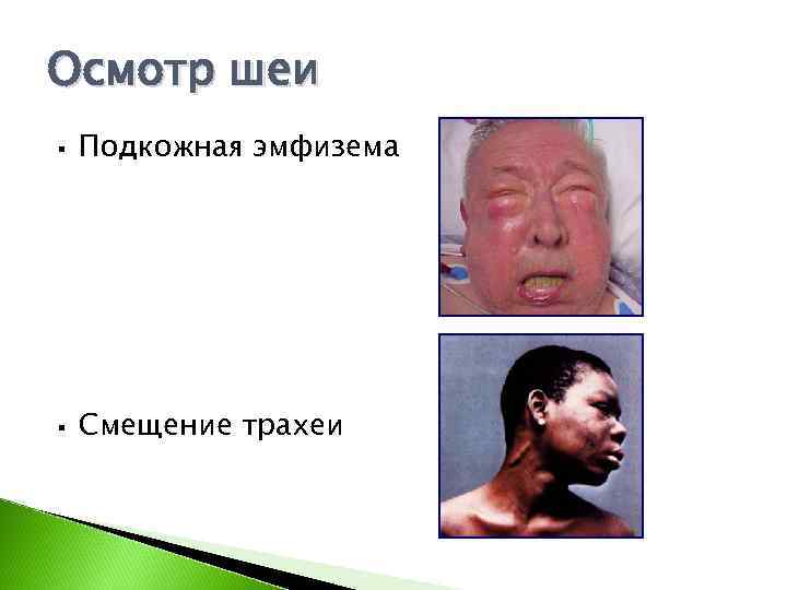 Осмотр шеи §  Подкожная эмфизема §  Смещение трахеи 