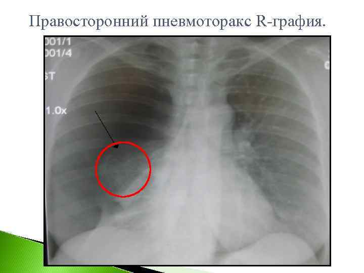 Правосторонний пневмоторакс R-графия. 