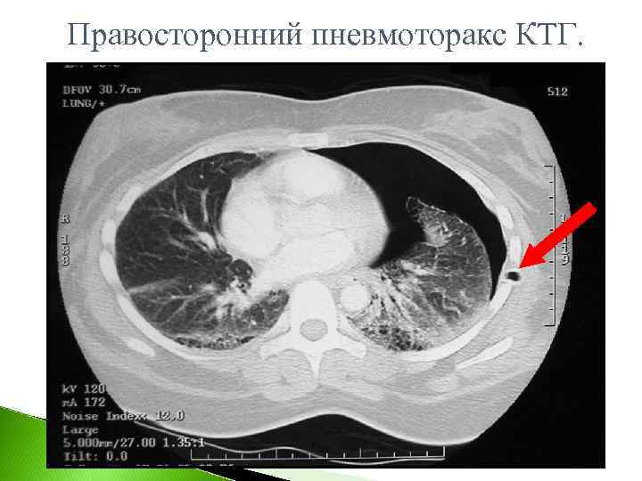 Правосторонний пневмоторакс КТГ. 