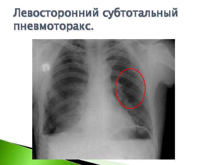 Левосторонний субтотальный пневмоторакс. 