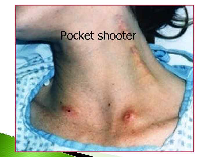 Pocket shooter 