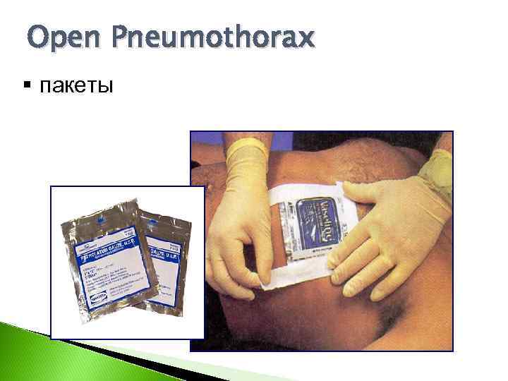 Open Pneumothorax § пакеты 