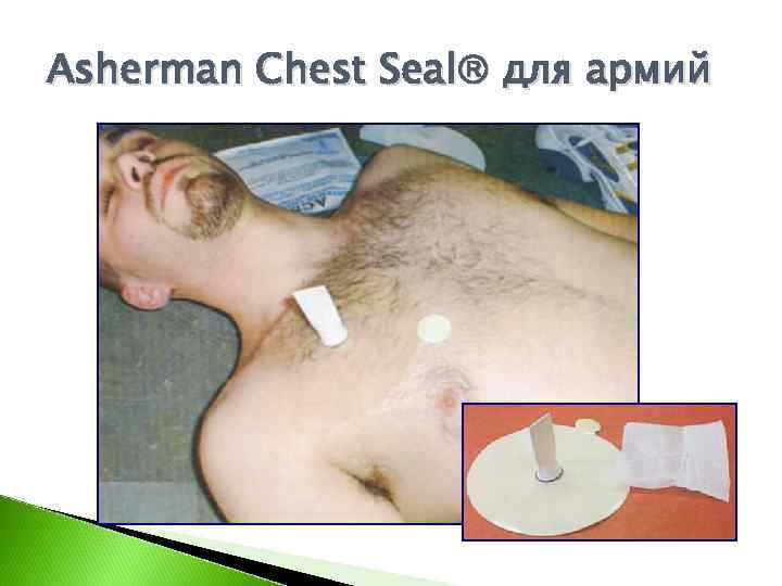 Asherman Chest Seal для армий 