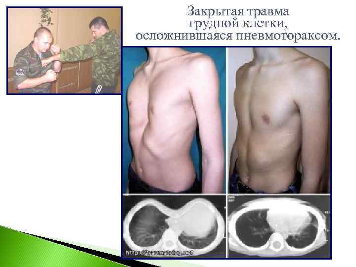   Закрытая травма   грудной клетки, осложнившаяся пневмотораксом. 