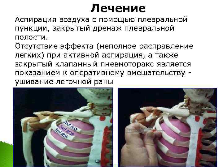    Лечение Аспирация воздуха с помощью плевральной пункции, закрытый дренаж плевральной полости.