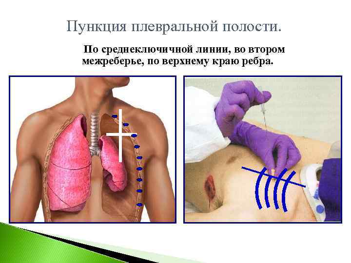 Пункция плевральной полости.  По среднеключичной линии, во втором  межреберье, по верхнему краю