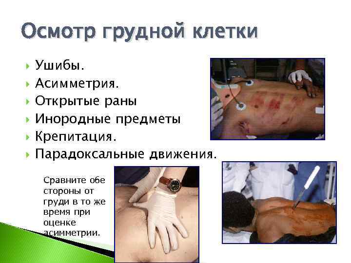 Осмотр грудной клетки Ушибы. Асимметрия. Открытые раны Инородные предметы Крепитация. Парадоксальные движения.  Сравните