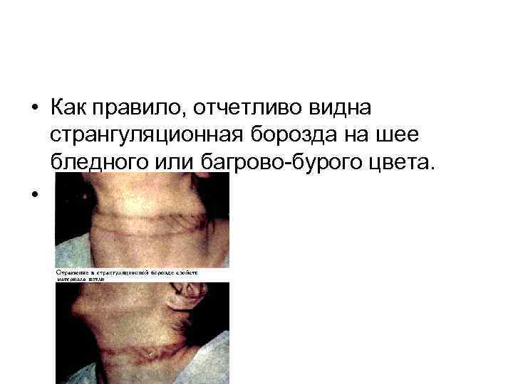  • Как правило, отчетливо видна  странгуляционная борозда на шее  бледного или