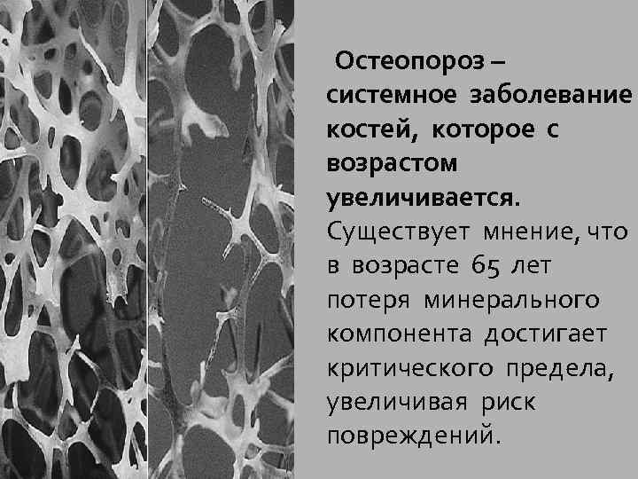  Остеопороз – системное заболевание костей, которое с возрастом увеличивается. Существует мнение, что в