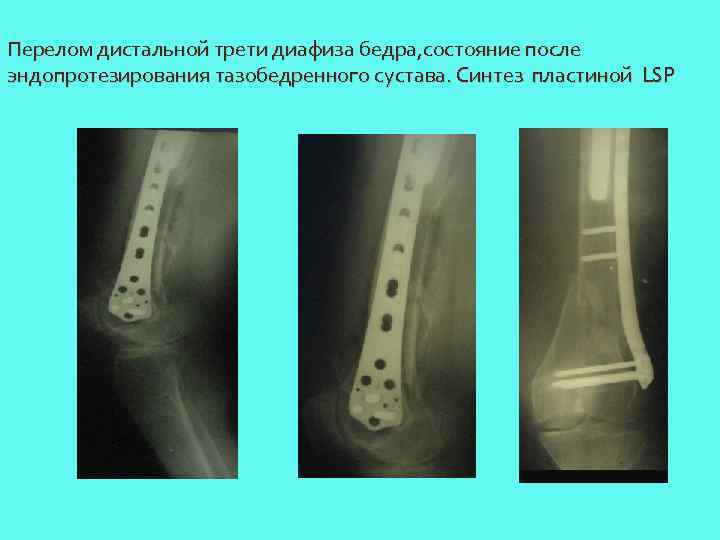 Перелом дистальной трети диафиза бедра, состояние после эндопротезирования тазобедренного сустава. Синтез пластиной LSP 