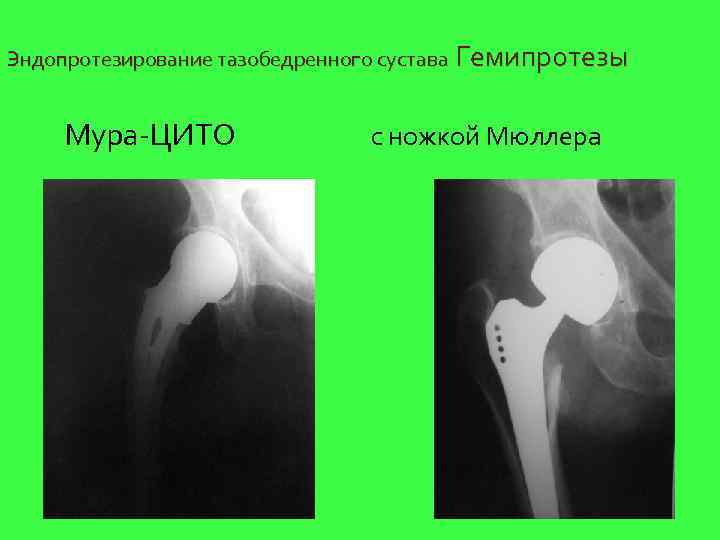 Эндопротезирование тазобедренного сустава Гемипротезы  Мура-ЦИТО   с ножкой Мюллера 