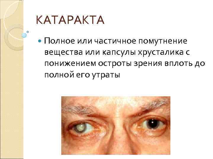 КАТАРАКТА  Полное или частичное помутнение вещества или капсулы хрусталика с понижением остроты зрения