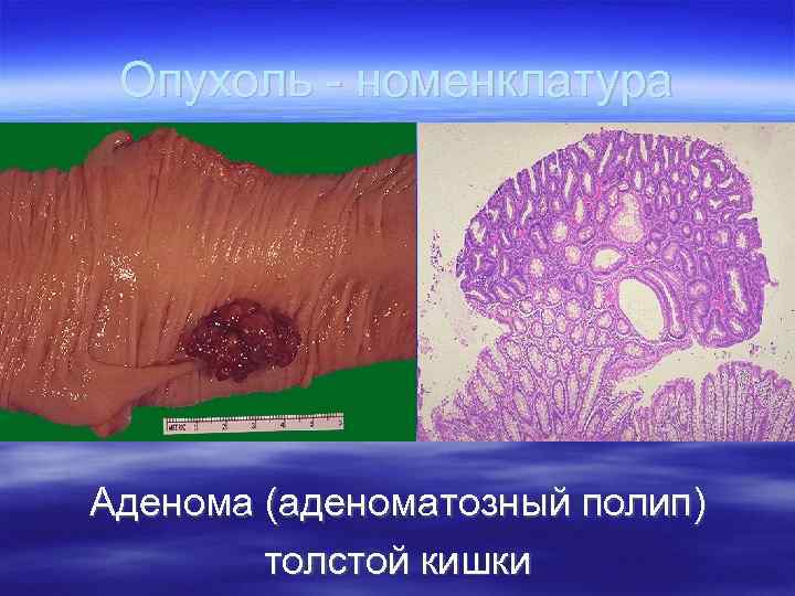  Опухоль - номенклатура Аденома (аденоматозный полип)   толстой кишки 