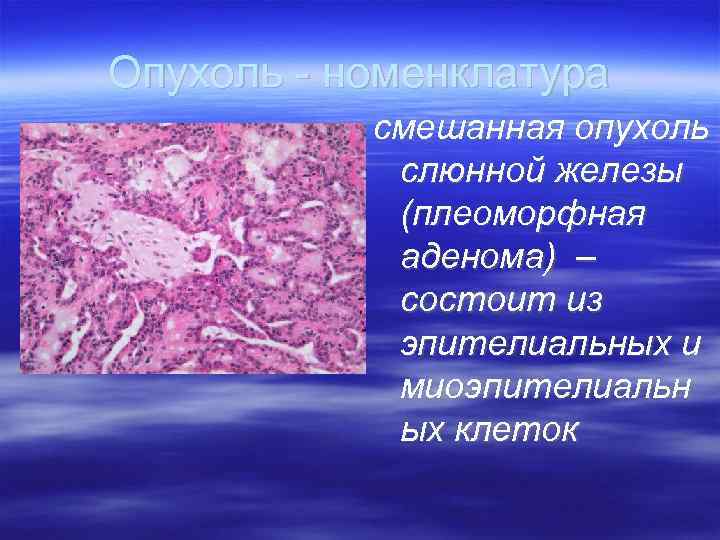 Опухоль - номенклатура  смешанная опухоль   слюнной железы   (плеоморфная 