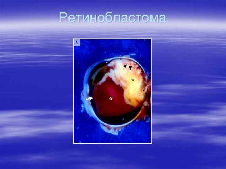 Ретинобластома 