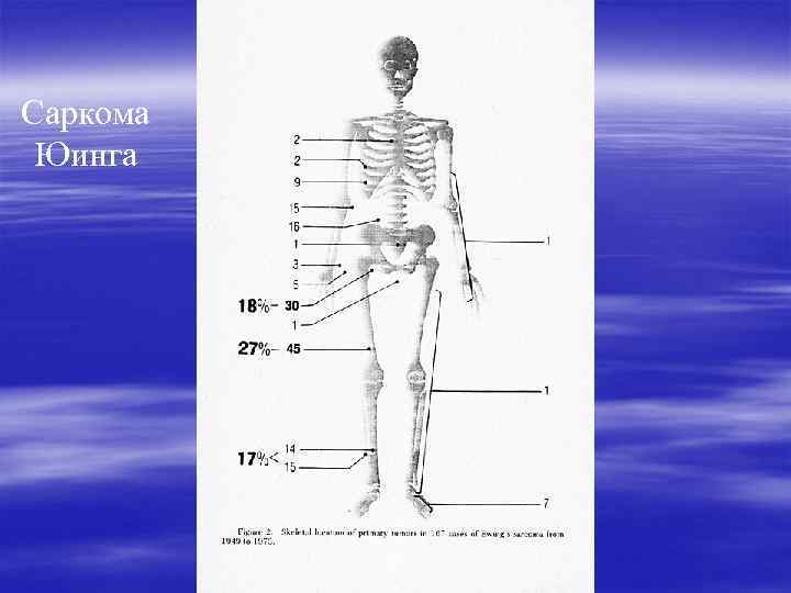 Саркома Юинга 