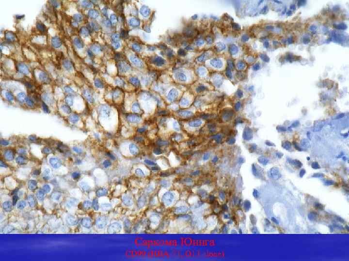  Саркома Юинга CD 99 (HBA-71, O 13 clone) 